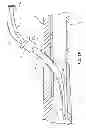 Fig. 04 - RAPID EXCHANGE TEMPORARY BLOOD FLOW CESSATION DEVICE FOR LARGE BORE CLOSURE