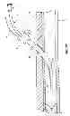 Fig. 05 - RAPID EXCHANGE TEMPORARY BLOOD FLOW CESSATION DEVICE FOR LARGE BORE CLOSURE