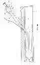 Fig. 06 - RAPID EXCHANGE TEMPORARY BLOOD FLOW CESSATION DEVICE FOR LARGE BORE CLOSURE