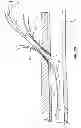 Fig. 09 - RAPID EXCHANGE TEMPORARY BLOOD FLOW CESSATION DEVICE FOR LARGE BORE CLOSURE
