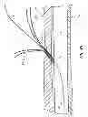 Fig. 10 - RAPID EXCHANGE TEMPORARY BLOOD FLOW CESSATION DEVICE FOR LARGE BORE CLOSURE