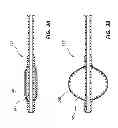 Fig. 11 - RAPID EXCHANGE TEMPORARY BLOOD FLOW CESSATION DEVICE FOR LARGE BORE CLOSURE