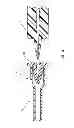 Fig. 12 - RAPID EXCHANGE TEMPORARY BLOOD FLOW CESSATION DEVICE FOR LARGE BORE CLOSURE