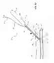 Fig. 13 - Vascular closure device with improved side loading