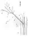 Fig. 14 - Vascular closure device with improved side loading