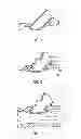 Fig. 02 - METHOD AND SYSTEM FOR CLOSING A VASCULAR HOLE