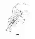 Fig. 06 - Sheaths for implantable fixation devices