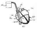 Fig. 01 - Heart stimulation device and respective control system