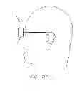Fig. 05 - Visual prosthesis with user interface