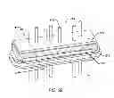 Fig. 26 - Low impedance oxide resistant grounded capacitor for an AIMD