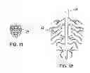 Fig. 06 - Method of treating atherosclerotic occlusive disease