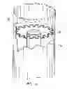 Fig. 12 - Method of treating atherosclerotic occlusive disease