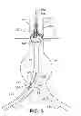 Fig. 04 - GATE WIRE FOR CONTRALATERAL LEG ACCESS