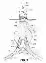 Fig. 05 - GATE WIRE FOR CONTRALATERAL LEG ACCESS