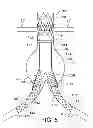 Fig. 06 - GATE WIRE FOR CONTRALATERAL LEG ACCESS