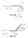 Fig. 15 - GATE WIRE FOR CONTRALATERAL LEG ACCESS