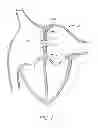 Fig. 02 - Devices and methods for coronary sinus pressure relief