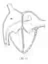 Fig. 13 - Devices and methods for coronary sinus pressure relief