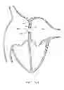 Fig. 28 - Devices and methods for coronary sinus pressure relief