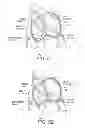 Fig. 49 - Devices and methods for coronary sinus pressure relief