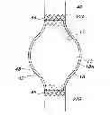 Fig. 01 - SAC LINER FOR ANEURYSM REPAIR