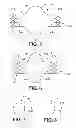 Fig. 04 - SAC LINER FOR ANEURYSM REPAIR