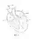 Fig. 02 - Devices and methods for heart valve repair