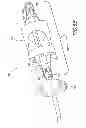 Fig. 08 - Methods and apparatuses for deploying minimally-invasive heart valves