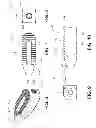 Fig. 05 - Percutaneous arthrodesis method and system