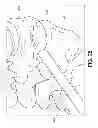 Fig. 19 - Percutaneous arthrodesis method and system
