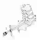 Fig. 20 - Percutaneous arthrodesis method and system