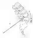 Fig. 22 - Percutaneous arthrodesis method and system