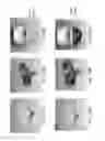 Fig. 197 - Patient-adapted and improved articular implants, designs and related guide tools
