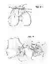 Fig. 04 - Marking template for installing a custom replacement device for resurfacing a femur and associated installation method