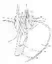 Fig. 01 - Multi valve anti-reflux prosthesis