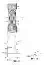 Fig. 02 - Multi valve anti-reflux prosthesis