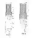 Fig. 08 - Multi valve anti-reflux prosthesis