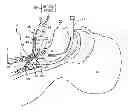 Fig. 01 - TRACHEAL DILATION APPARATUS AND METHOD OF MANUFACTURE