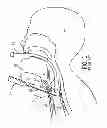 Fig. 02 - TRACHEAL DILATION APPARATUS AND METHOD OF MANUFACTURE