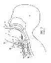 Fig. 03 - TRACHEAL DILATION APPARATUS AND METHOD OF MANUFACTURE