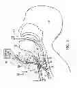 Fig. 04 - TRACHEAL DILATION APPARATUS AND METHOD OF MANUFACTURE