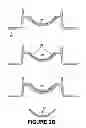 Fig. 04 - Method of ring-shaped structure placement in an eye-mountable device