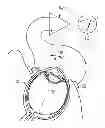 Fig. 01 - Electrooculogram as a control in a hearing assistance device