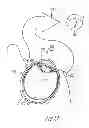 Fig. 02 - Electrooculogram as a control in a hearing assistance device