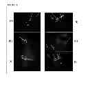Fig. 14 - METHOD OF REDUCING MULTI-DRUG RESISTANCE USING INOSITOL TRIPYROPHOSPHATE