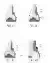 Fig. 05 - Hydraulic pressure dental impression