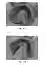 Fig. 14 - Hydraulic pressure dental impression