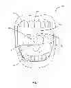 Fig. 02 - DENTAL TRAP