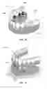 Fig. 13 - Dental retention systems