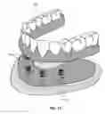 Fig. 14 - Dental retention systems